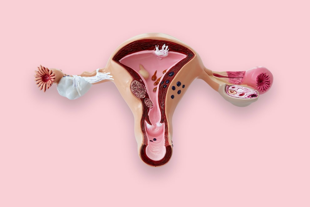 Gebärmutter und eierstockentfernung