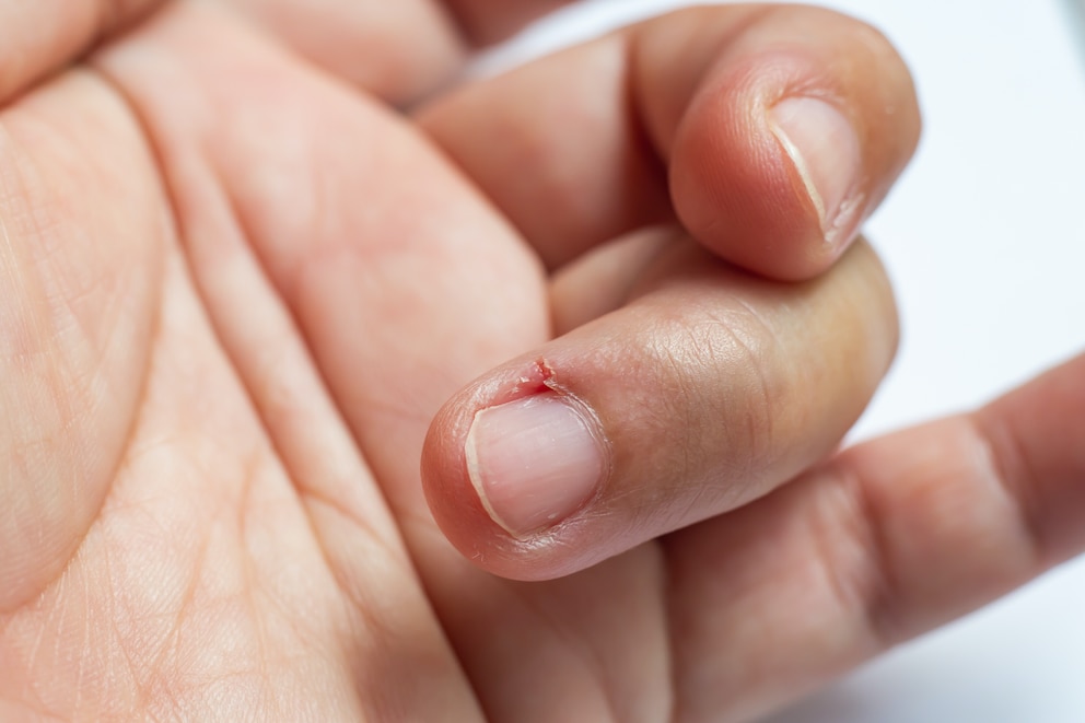 Nietnagel-am-Fingernagel-loswerden-die-besten-Tipps-vom-Arzt